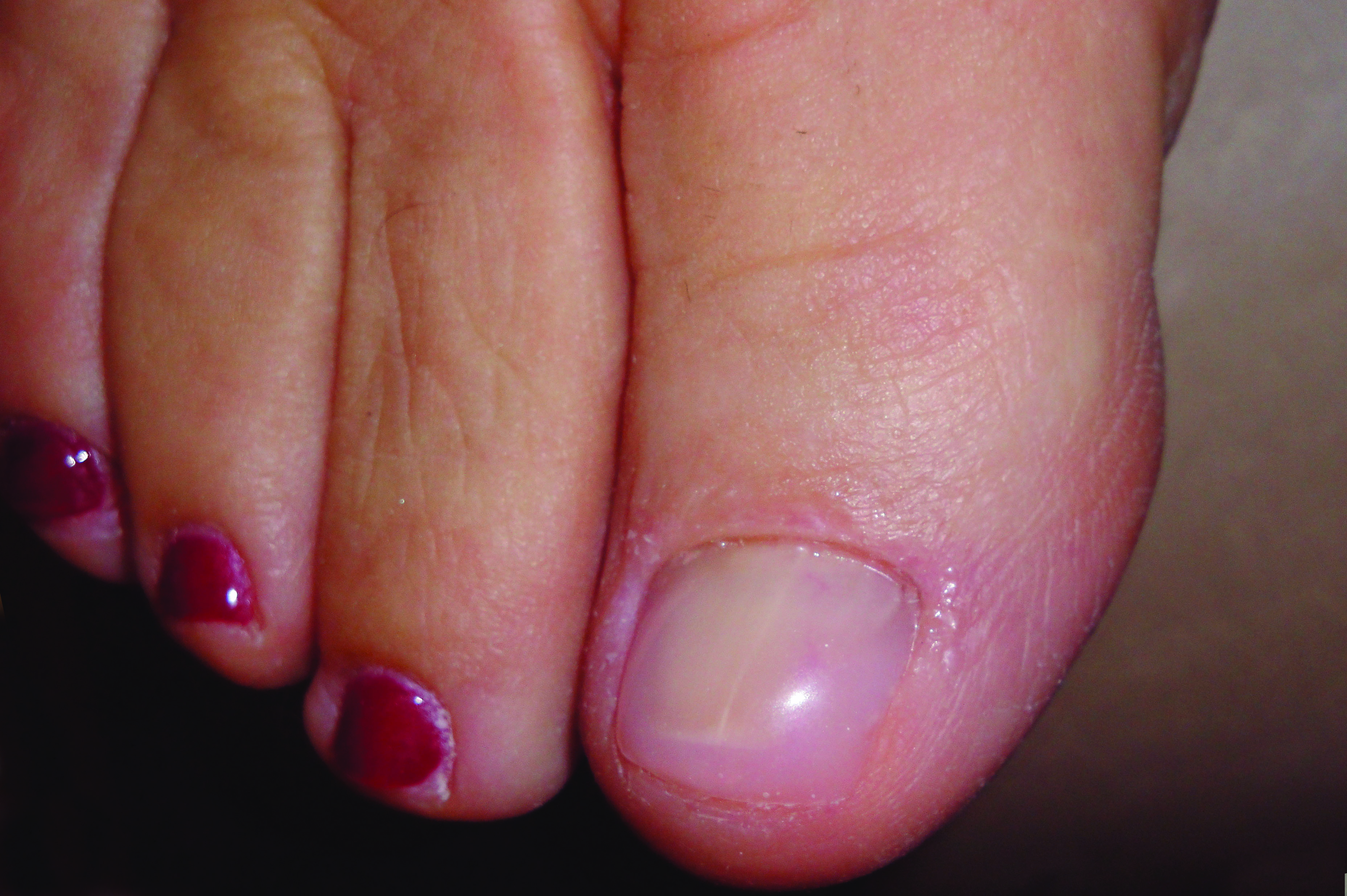 WeTreatFeet Podiatry , MD and PA Podiatrists, Ingrown nail care