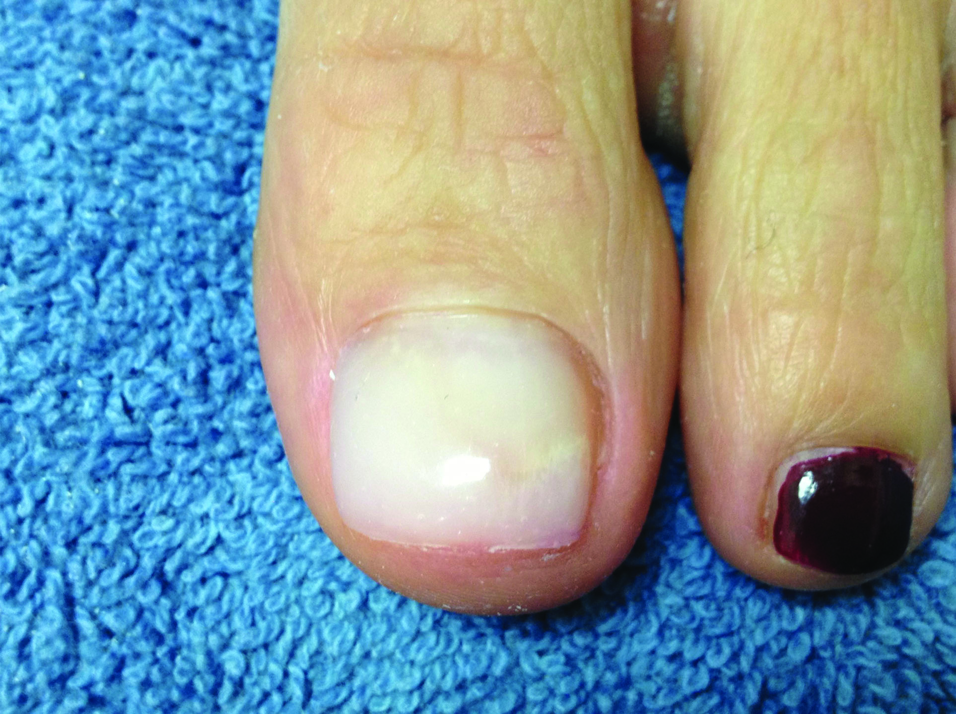 After Keryflex Nail Restoration — Sole Wellness & Aesthetics