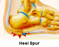 Heel Spur