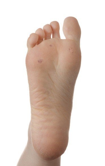 Wart on foot growing